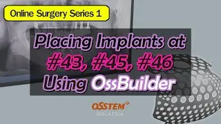 Placing Implants at #43, #45, #46 Using OssBuilder