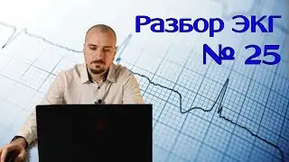 Разбор ЭКГ № 25