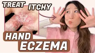 How to Treat Hand Eczema 🖐️ Dr. Joyce Dermatologist