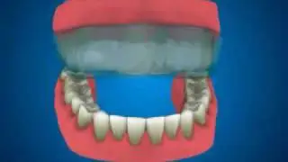 Отбеливание