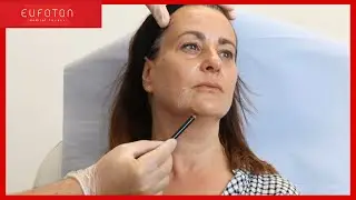 Endolift® Webinar Live | Dr Ghanem & Dr Verma [Eufoton®]