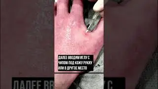 Установка RFID/NFC чипа людям. Чипирование.