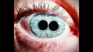My wife suffered a head injury. Now she has four pupils instead of two - Reddit Scary Story