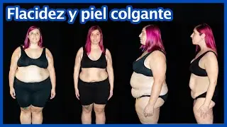 Bypass gástrico -  Flacidez y piel colgante