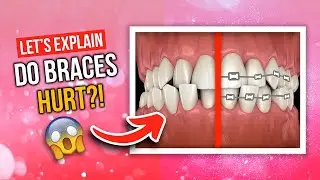 Do Braces Hurt?!