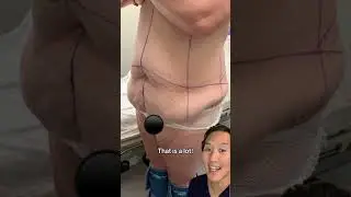Tummy Tuck Before And After Removal of 10 Lbs! 