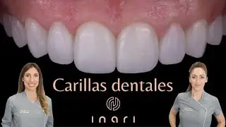Carillas Dentales