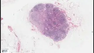 Breast: Invasive lobular carcinoma with lymph node metastases Microscopy (Talking slide)