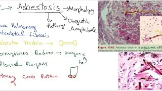 Pneumoconiosis Part 2- Asbestosis Morphology and Pathology@Dr.M-Usman