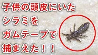頭皮にいたアタマジラミをガムテープで捕まえた！！ |  Discovery of louse