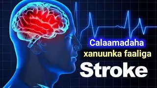 Calaamadaha hordhaca u ah xanuunka faaliga ( stroke )
