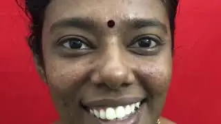 Facial asymmetry correction in south india