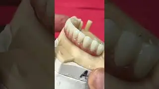 All-On-4 Zirconia with no Ti-Base 