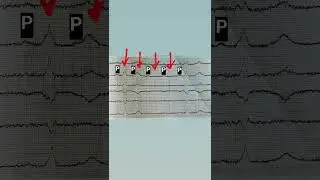 #гипермагнезиемия #экг #экгпроще #ecg