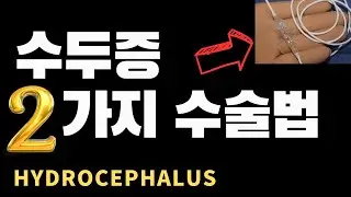 수두증 2부, 치매, 뇌수술, hydrocephalus, 치매 수술 #신경외과 #건강정보 #치매 #뇌졸중 #수두증