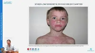 балалардағы жұқпалы мононуклеоз