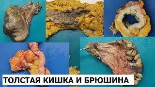 Рак толстой кишки #3 - опухоль и брюшина, хирургический край резекции.