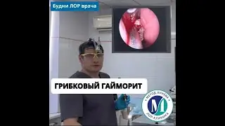 Хронический гайморит.