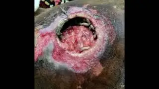 Maggots in bed sores