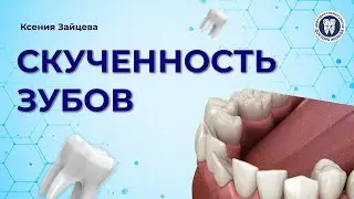 Скученность зубов, чем она опасна и как её устранить?