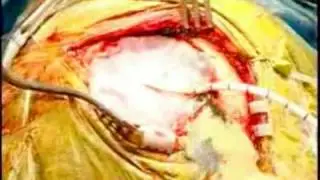 BRAIN TUMOR - TUMOR CEREBRAL