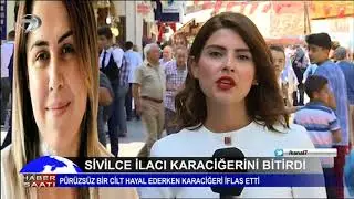 Sivilce ilacı karaciğerini bitirdi! Pürüzsüz bir cilt hayal ederken karaciğeri iflas etti