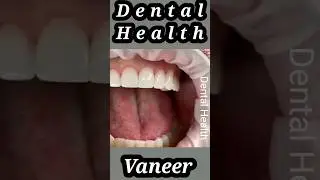 dental Veneer #Shorts