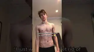 Fixed the hole in my chest ! Body transformation pectus