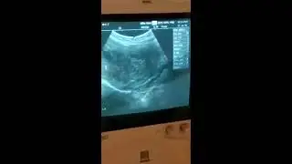 Comparto caso Mioma y Embarazo de 15 SEMANAS .