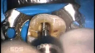 Flexi-Post Placement Video