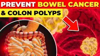 8 Yellow Foods To Prevent Bowel Cancer And Colon Polyps (Must eat)