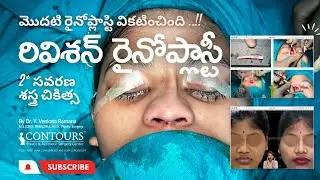 రివిశన్ రైనోప్లాస్టీ | 2వ సవరణ శస్త్ర చికిత్స | REVISION RHINOPLASTY | వికటించిన రైనోప్లాస్టీ  |