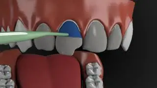 Cosmatic veneers - Preparation and placement of dental veneers