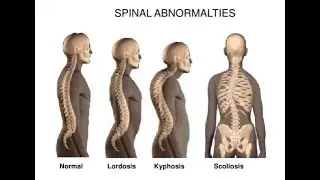 Differences between Scoliosis, Kyphosis and Lordosis