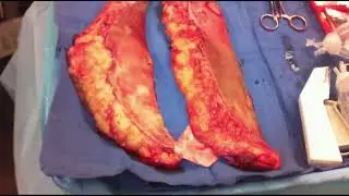 Placement of a well-fixed narrow retrorectus mesh
