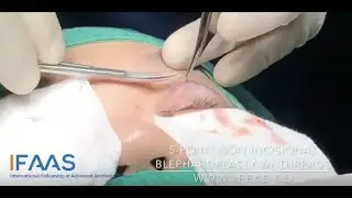 IFAAS Exclusive Techniques: 5-Point Non Incisional Blepharoplasty with Threads