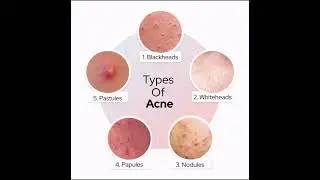 Knowledge about Acni     