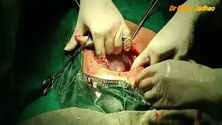 Caesarean section of twins with both fetuses in breech presentation.