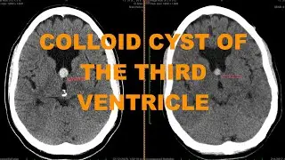 Clinical case - enlarging colloid cyst of the third ventricle - important finding not to miss on CT