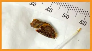 Jerry's Earwax Removal