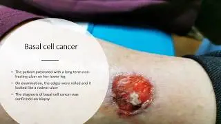 basal cell cancer leg