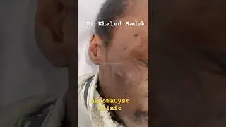 Massive face cyst #skincare #cystremoval Dr Khaled Sadek
