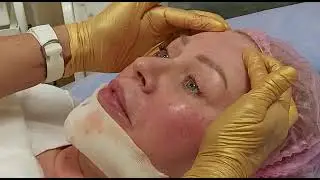 Пятиступенчатое супер омолаживание лица в один приём (ботокс, филлер, мезотерапия, биоревитализация)