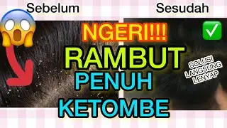 NGERI KULIT KEPALA PENUH KETOMBE CARA TERCEPAT MENGHILANGKAN KETOMBE DI RAMBUT SECARA PERMANEN ALAMI