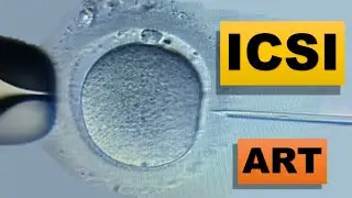 Intracytoplasmic Sperm Injection (ICSI) | ART | Infertility | Reproductive Health
