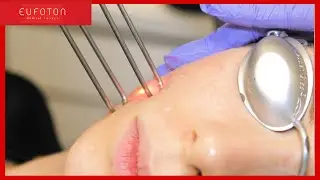 🇬🇧 Skin rejuvenation treatment | LASEmaR® 1500 & LightScan™ - Nova Clinic's testimony [Eufoton®]