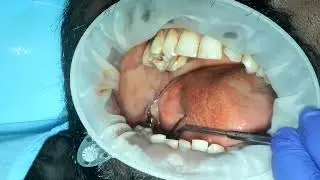 part 2 - buccal welding