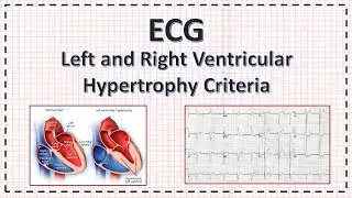 Left and Right Ventricular Hypertrophy ECG criteria | LVH | RVH | ECG | Simplified.