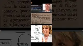 Laryngectomie