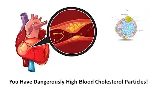 You Have Dangerously High Blood Cholesterol Particles: A Discussion On LDL And HDL